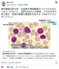 潜伏期間は約50年…白血病や神経難病のリスクとなるウイルス「HTLV-1」国内は65万人が感染、うち半分は縄文人ルーツが多い九州に集中のイメージ画像