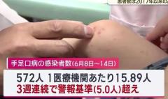 手足口病が８週連続で増加 患者数は２０１７年以来の高水準のイメージ画像