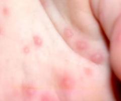 「赤い水ぶくれ」重症化すれば死亡も…14人が集団感染、台湾社会に衝撃のイメージ画像