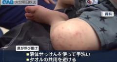 手足口病が流行 患者数が警報基準超え 県が２年ぶり警報のイメージ画像