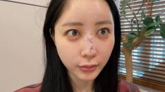 【ふくれな】韓国で鼻整形をした様子を公開！ダウンタイムについても言及のイメージ画像