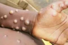 「エムポックス」の新たな変異株、イングランドで検出のイメージ画像