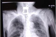 高齢男性の喉から“鍵”、死因はコロナ？ 遺族が病院提訴「真実を知りたい」のイメージ画像
