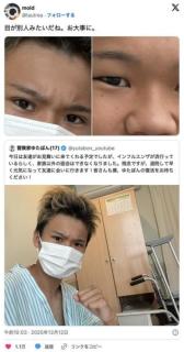 【悲報】ゆたぼん、事故の治療費をネットで乞食して整形代に使ってる疑惑浮上wwwwwwwのイメージ画像