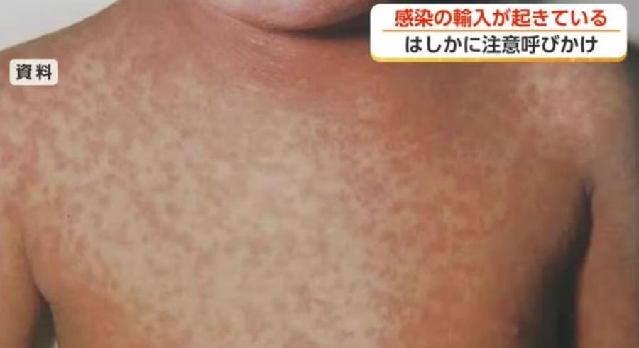 はしか感染が全国で急増 富山県が予防接種の確認を呼びかけ