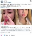 韓国で整形手術「鼻が歪んだ」痛々し..