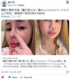 韓国で整形手術「鼻が歪んだ」痛々しいショット…ベトナム人気DJ、感染症で涙
