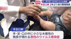 【長崎】手や足に発疹が現れる「手足口病」２年ぶりに流行警報を発表のイメージ画像
