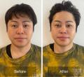 ノンスタ井上“顔の美容施術”のビフォーアフター公開、「すごい！顔が違う…」と反響
