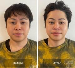 ノンスタ井上“顔の美容施術”のビフォーアフター公開、「すごい！顔が違う…」と反響のイメージ画像