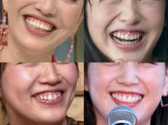 笑うと「歯茎」が目立つ…「ガミースマイル」はなぜ起こる？ 歯科医師に聞いて分かった“4つの原因”のイメージ画像