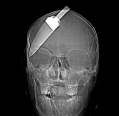 妻の頭に包丁を突き刺した疑い 20代の男を逮捕 沖縄・名護署