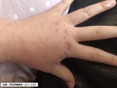 手足口病がさらに増加 1週間で347人と前週の約1.6倍 警報レベルの流行続く 新潟のイメージ画像
