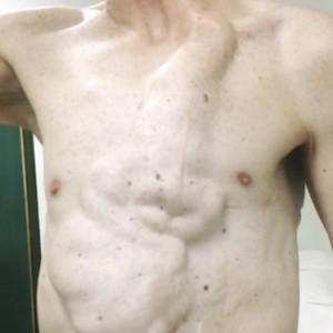 🌎ドイツ 50年前の手術で内臓の形がわかるようになった男