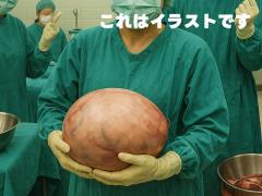 「太ったと思っていたら…」31歳女性の腹部から8kgの卵巣嚢腫摘出【必見あるいは閲覧注意】のイメージ画像